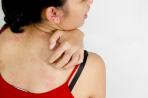 Jak złagodzić objawy atopowego zapalenia skóry?